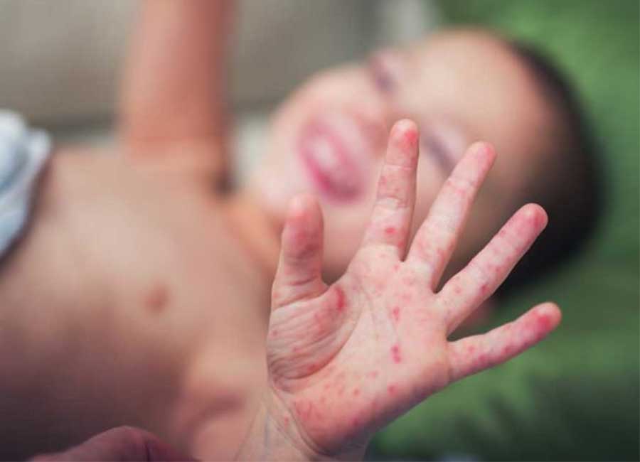 Measles outbreak in Dublin as confirmed cases rise