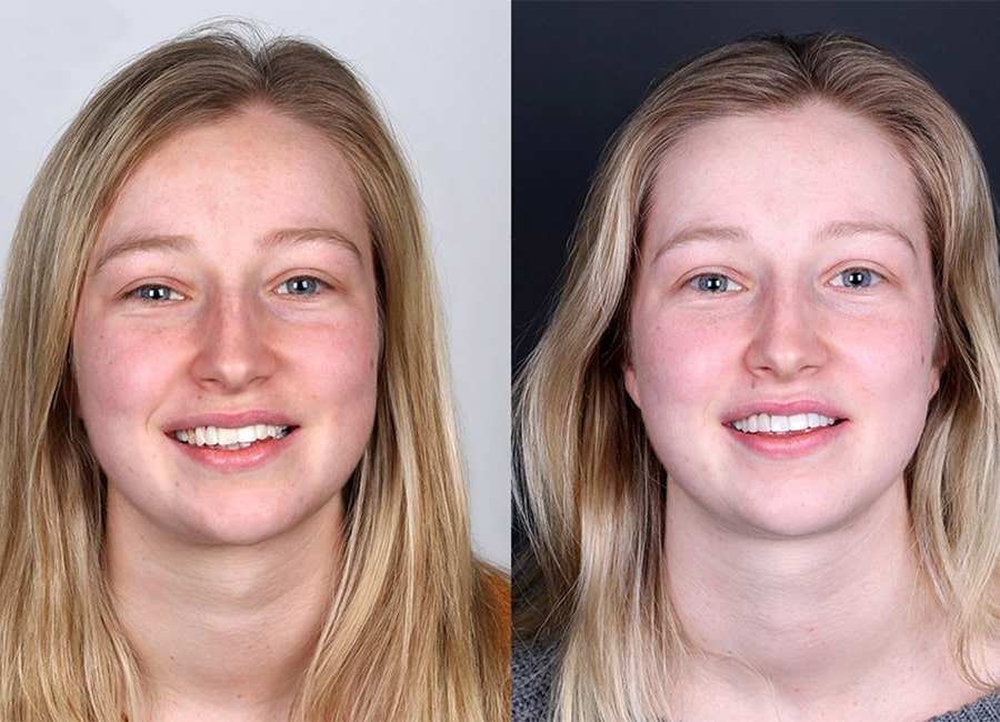 veneers Seapoint Clinic