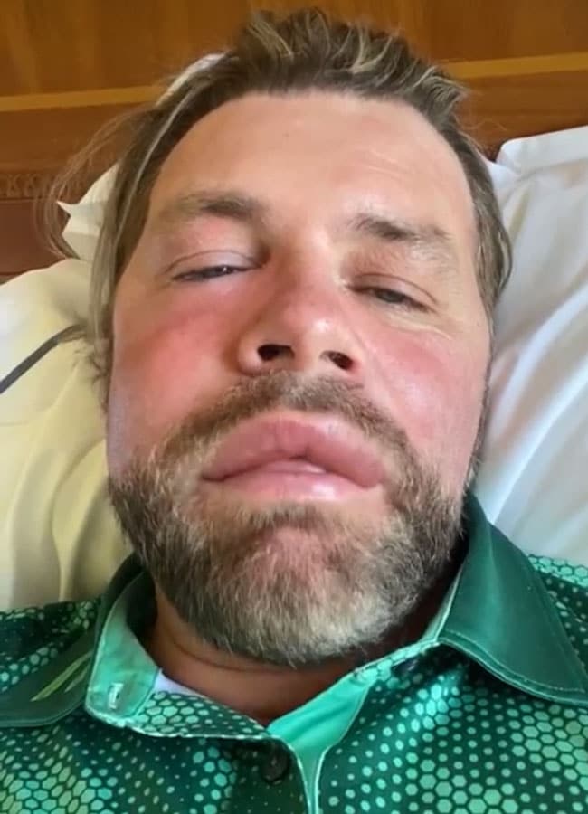 brian mcfadden bee sting 3